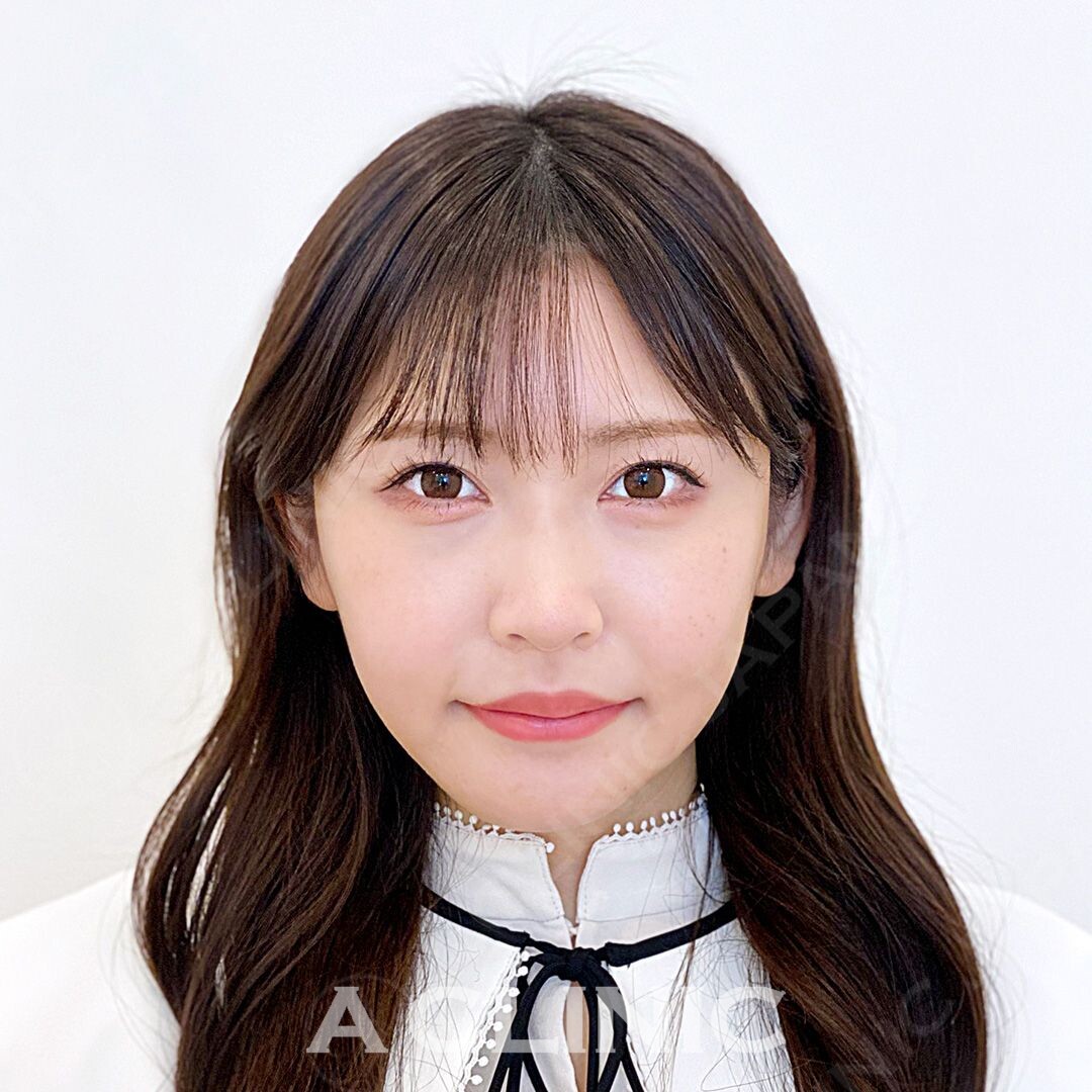 Aスレッドで小顔になりさらに可愛く愛されフェイスに！処置前と処置直後の症例です(20代女性) BEFORE