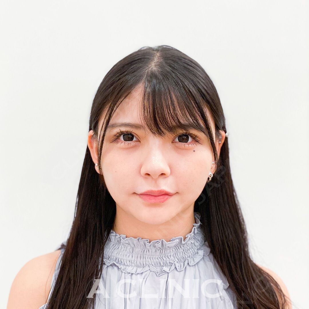 周りから憧れられるような綺麗なVフェイスに大変身！Aスレッドの処置前と処置直後の症例です(20代女性) BEFORE