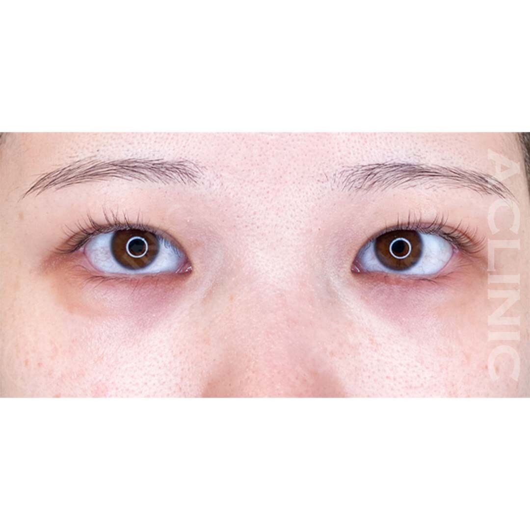 パーフェクトアイズでお目元がぱっちり大きくなりました！処置前と2週間後の症例です(20代女性) AFTER