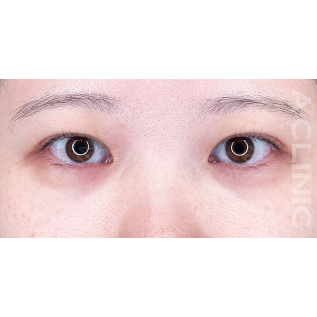 パーフェクトアイズでお目元がぱっちり大きくなりました！処置前と2週間後の症例です(20代女性) BEFORE