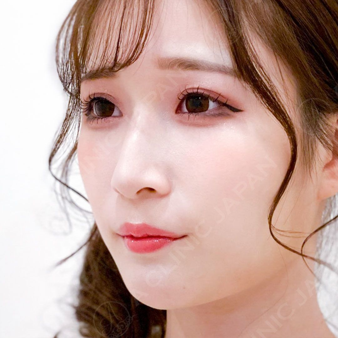 ワシ鼻を改善しまっすぐ綺麗な鼻に変身 パーフェクトノーズ処置前と2週間後の症例です 代女性 A Clinicは小顔 リフトアップ専門の美容整形クリニック