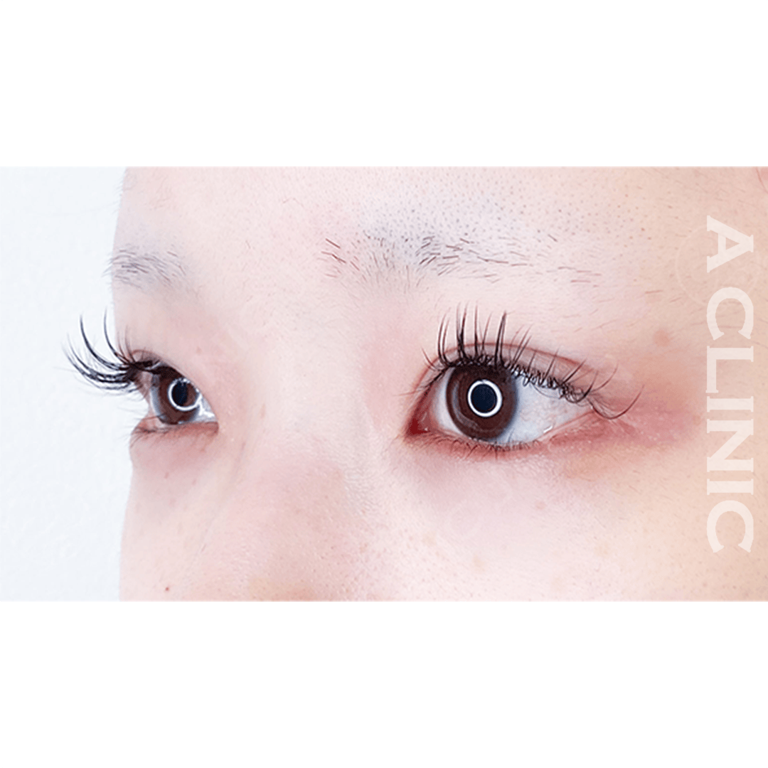 メイクなしでも愛されたれ目に！パーフェクトアイズ処置前と２週間後の症例です(20代女性) AFTER