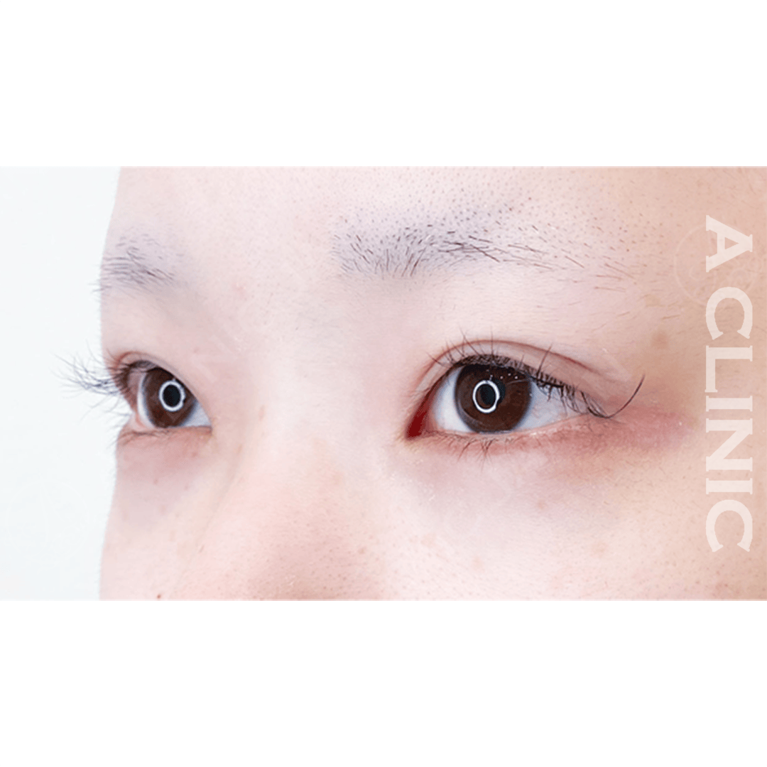 メイクなしでも愛されたれ目に！パーフェクトアイズ処置前と２週間後の症例です(20代女性) BEFORE