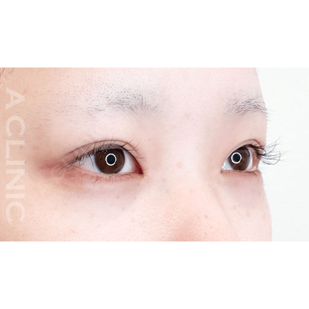 すっぴんでも可愛いお目元に！パーフェクトアイズ処置前と２週間後の症例です(20代女性) BEFORE