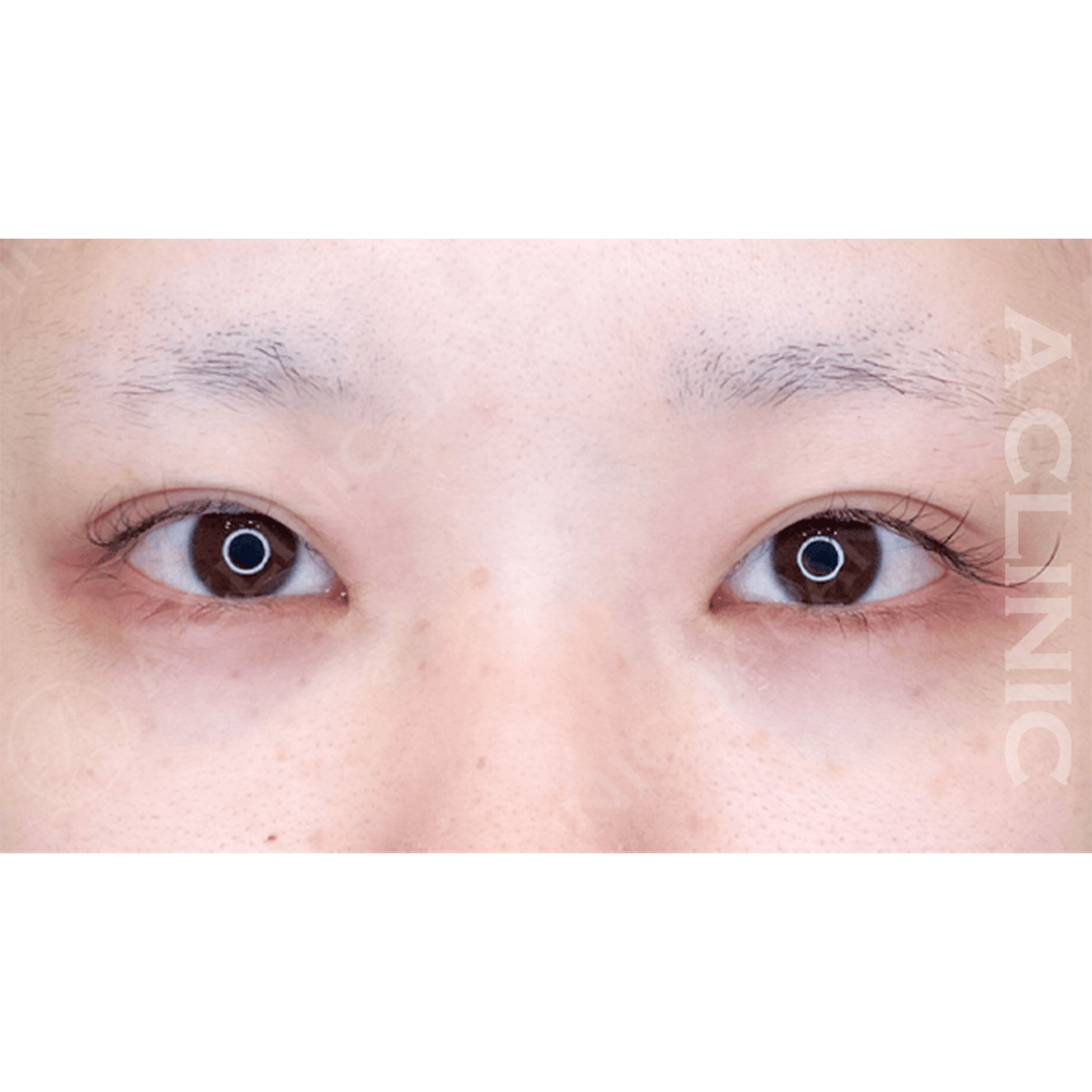 パーフェクトアイズで優しい印象に！処置前と２週間後の症例です(20代女性) BEFORE