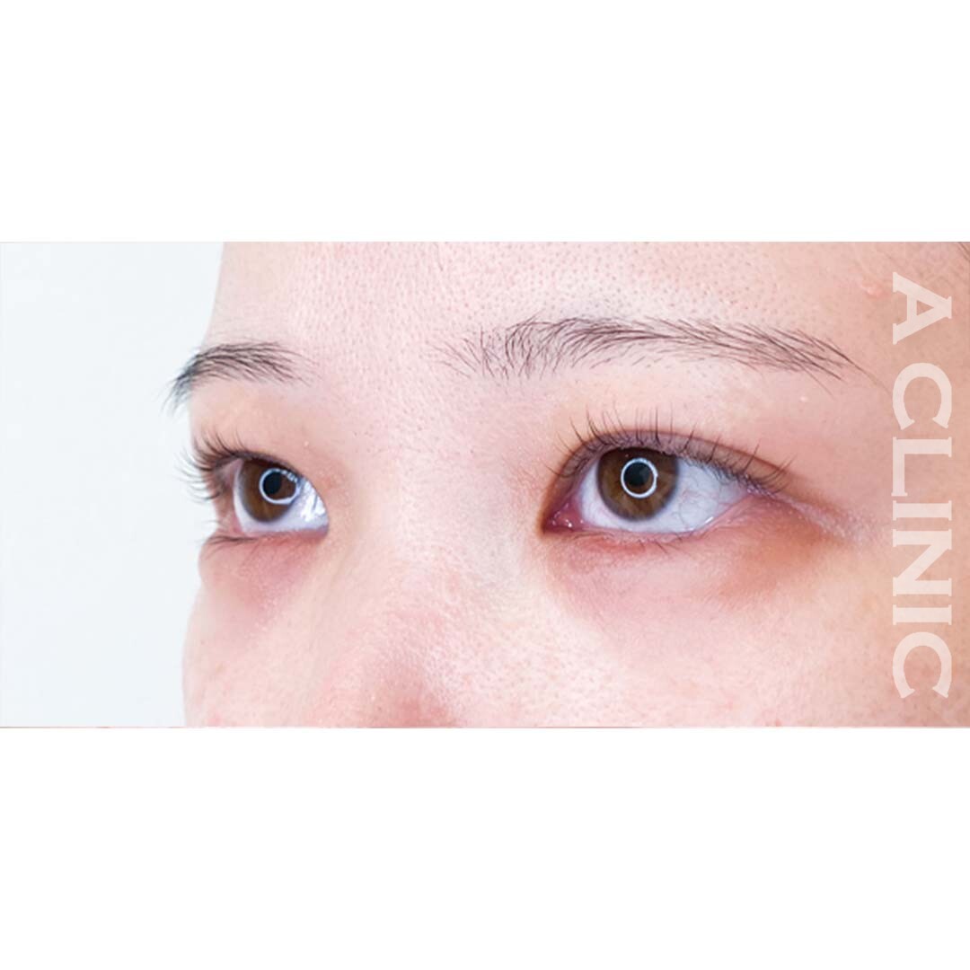 すっぴんでもタレ目になりかわいらしい印象に！パーフェクトアイズの処置前と2週間後の症例です(20代女性) AFTER