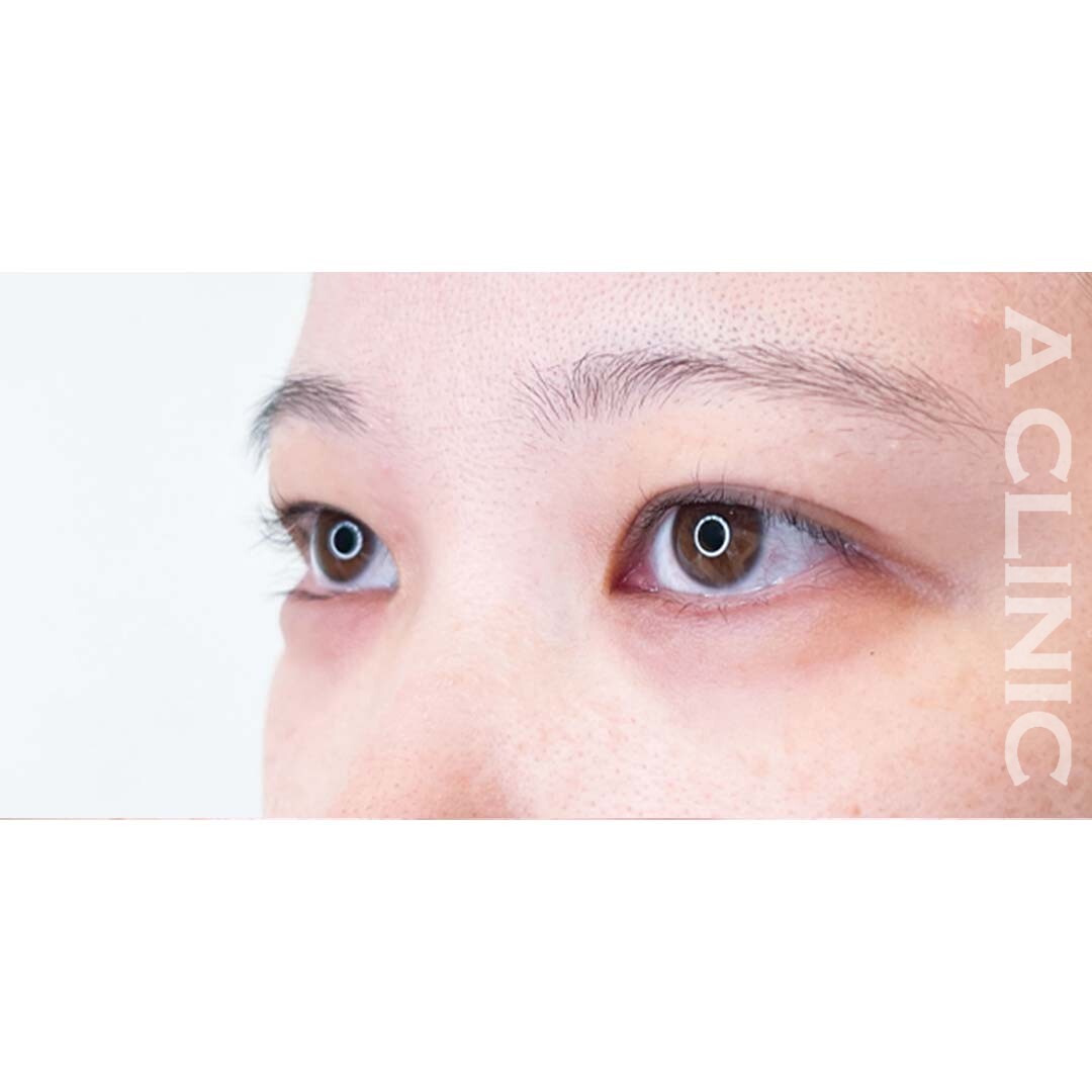 すっぴんでもタレ目になりかわいらしい印象に！パーフェクトアイズの処置前と2週間後の症例です(20代女性) BEFORE