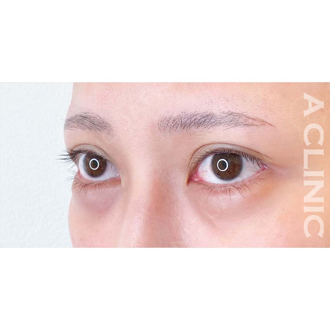 パーフェクトアイズで白目の余白を広げることでパッチリ可愛いお目元に！処置前と2週間後の症例です(20代女性) AFTER