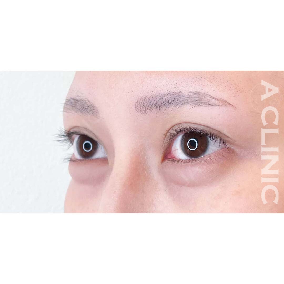 パーフェクトアイズで白目の余白を広げることでパッチリ可愛いお目元に！処置前と2週間後の症例です(20代女性) BEFORE