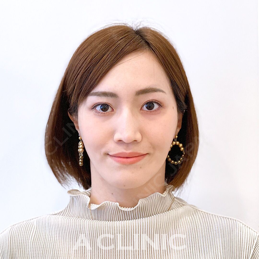 Aスレッドでお顔のたるみが引き上がりさらに美人フェイスに！処置前と処置直後の症例です(30代女性) AFTER