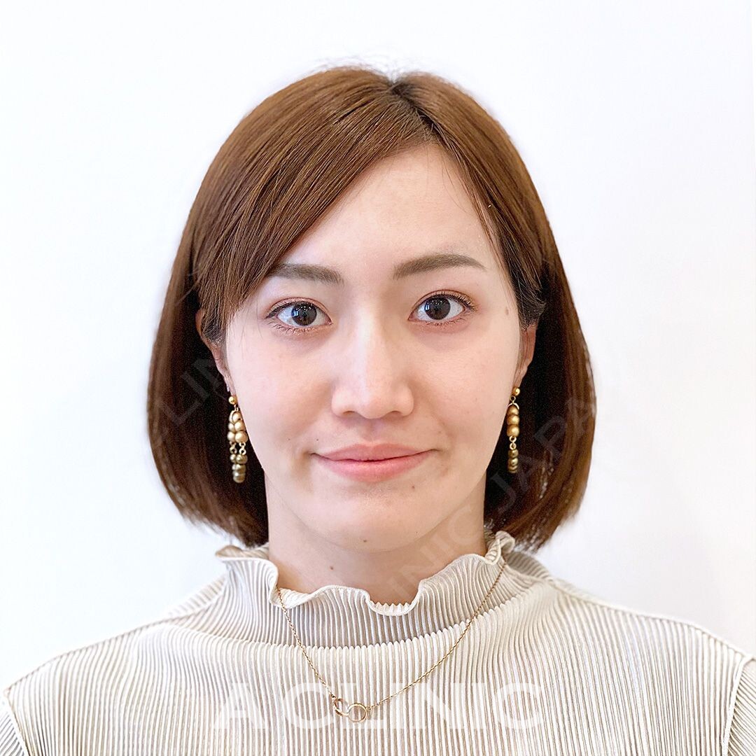 Aスレッドでお顔のたるみが引き上がりさらに美人フェイスに！処置前と処置直後の症例です(30代女性) BEFORE