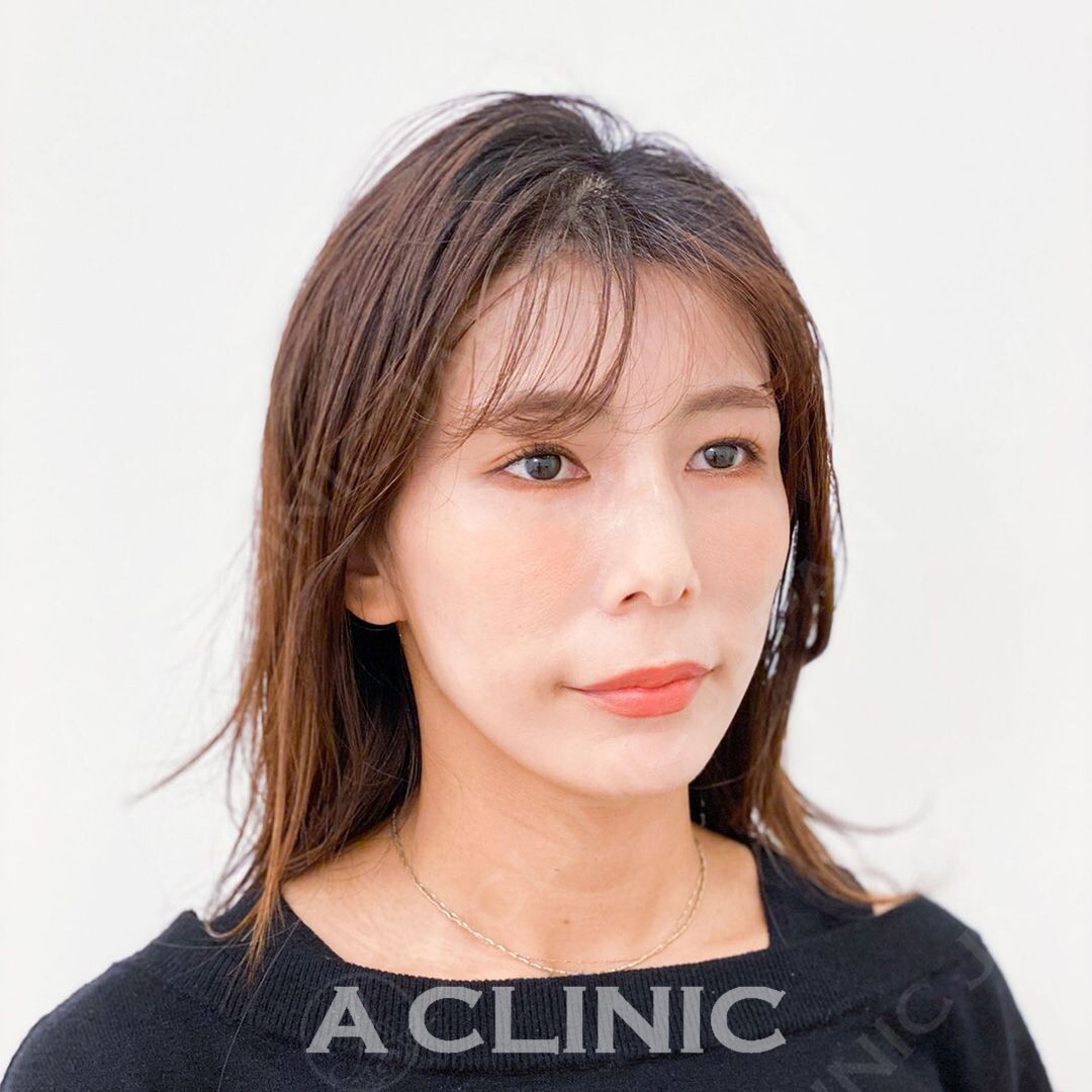 Aスレッドでフェイスラインのもたつきも当日からスッキリシャープに！処置前と処置直後の症例です(30代女性) AFTER