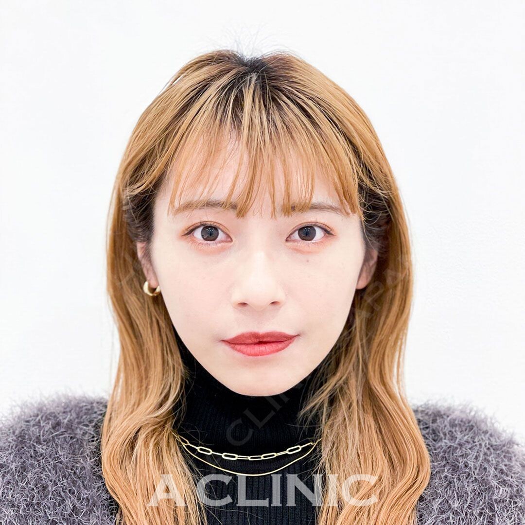 綺麗なVフェイスを当日から実感！Aスレッドの処置前と処置直後の症例です(20代女性) AFTER