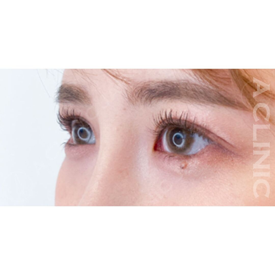 パーフェクトアイズで可愛らしいお目元に！自然なタレ目でお目元を大きく見せます！処置前と2週間後の症例です。(20代女性) AFTER