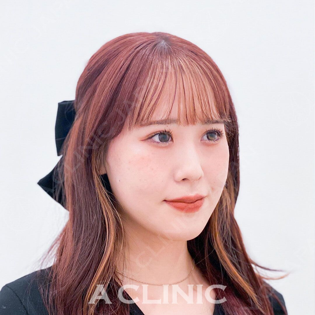 ダウンタイム最小限で直後から小顔に！当日お友達とお出かけも出来ちゃいます！Aスレッドの処置前と処置直後の症例です(20代女性) AFTER