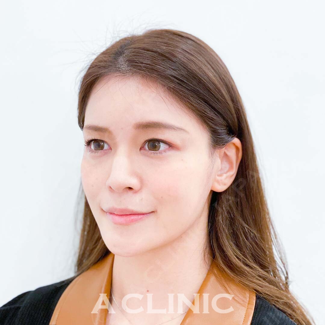 直後からしっかりリフトアップし小顔に！Aスレッドの処置前と処置直後の症例です(30代女性) AFTER