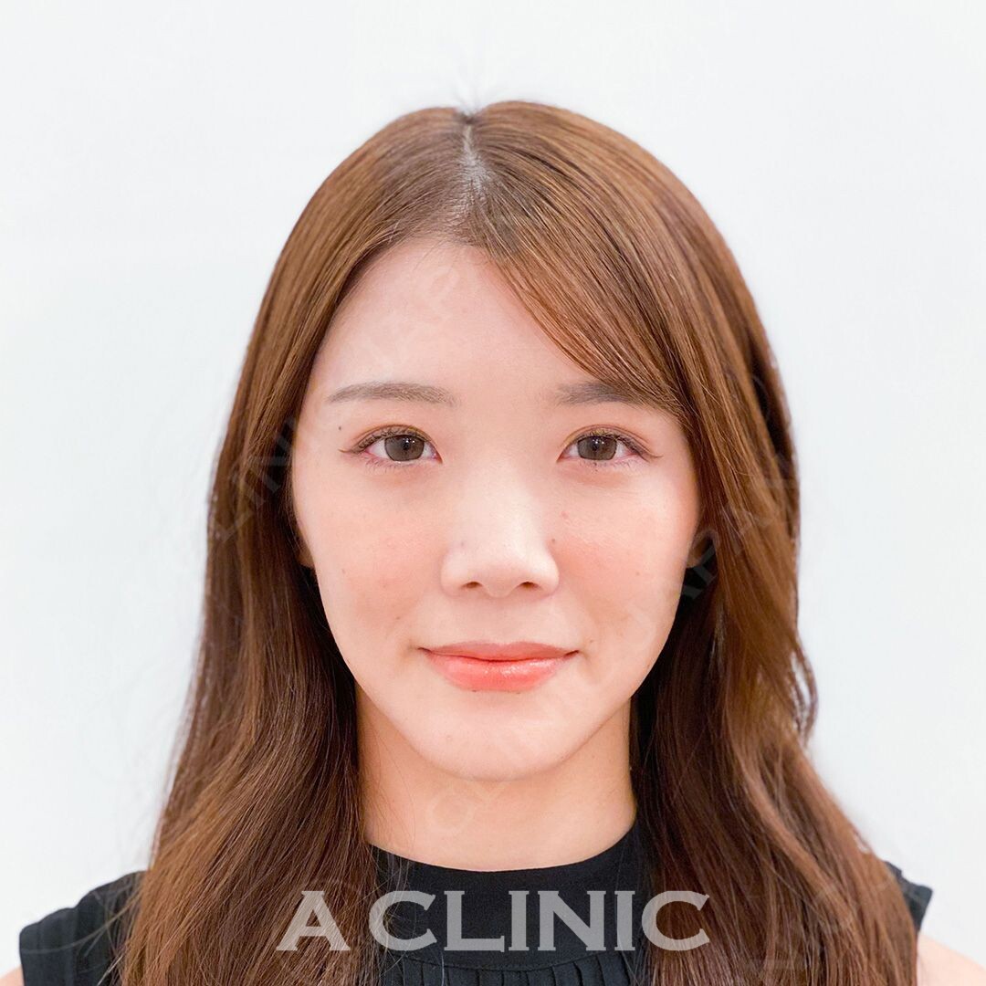 Aスレッドでお悩みの頬のもたつきもしっかり当日から解消！処置前と処置直後の症例です(20代女性) AFTER