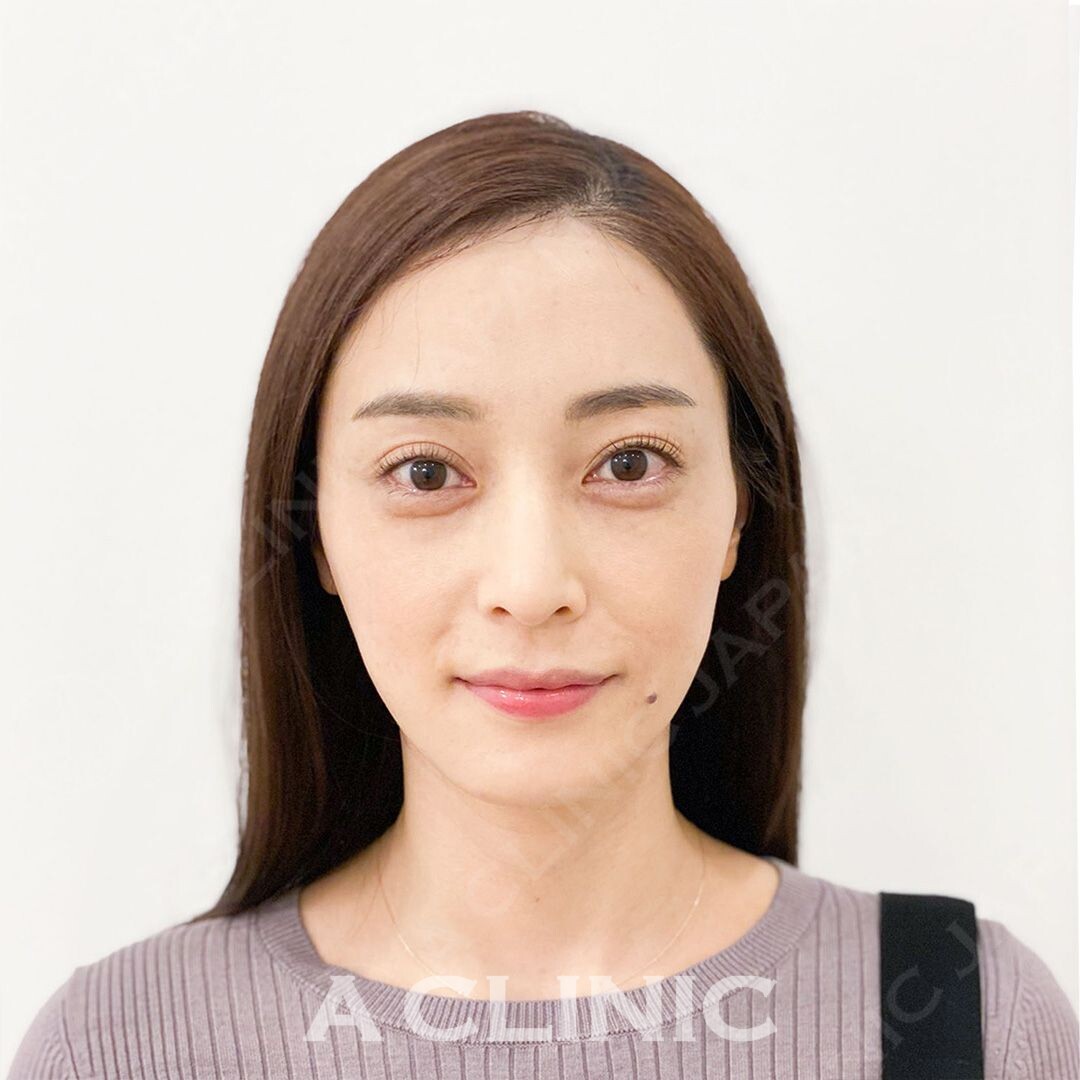 Aスレッドで頬のもたつきもしっかり解消！処置前と処置直後の症例です(30代女性) AFTER