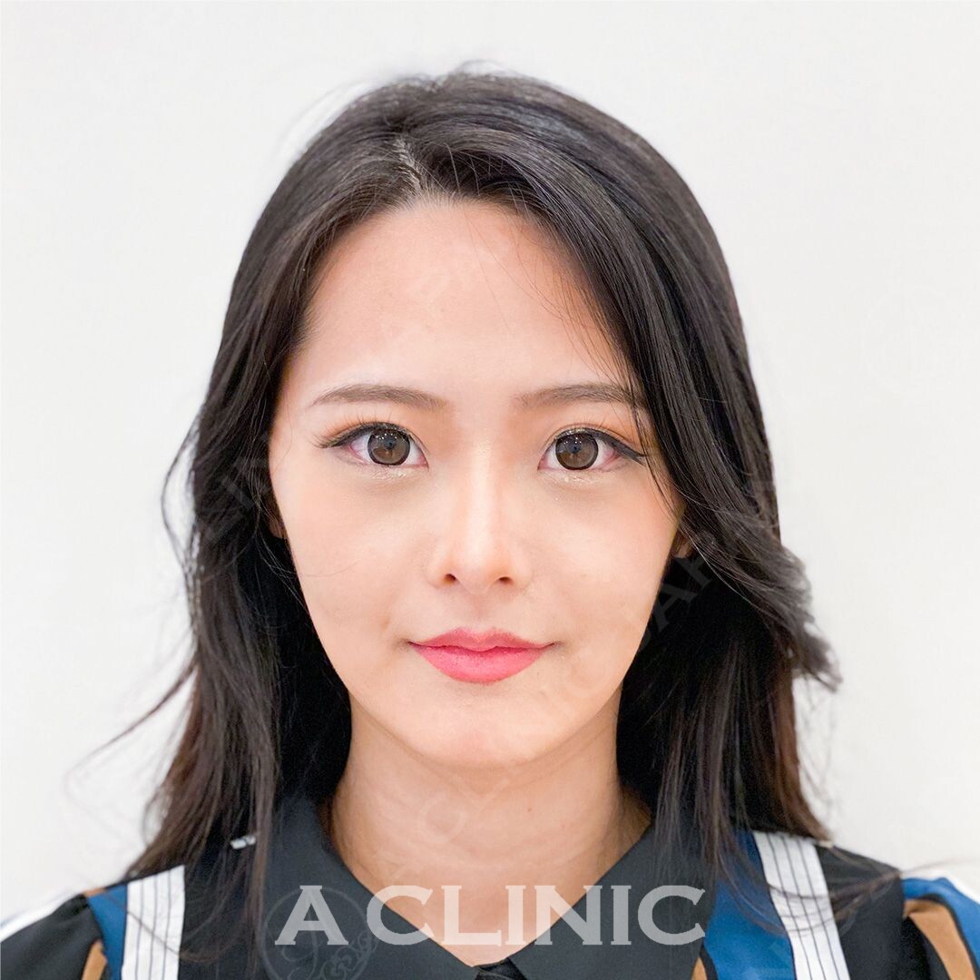 頬のたるみによるもたつきを即日解消！Aスレッド処置前と処置直後の症例です(20代女性) AFTER