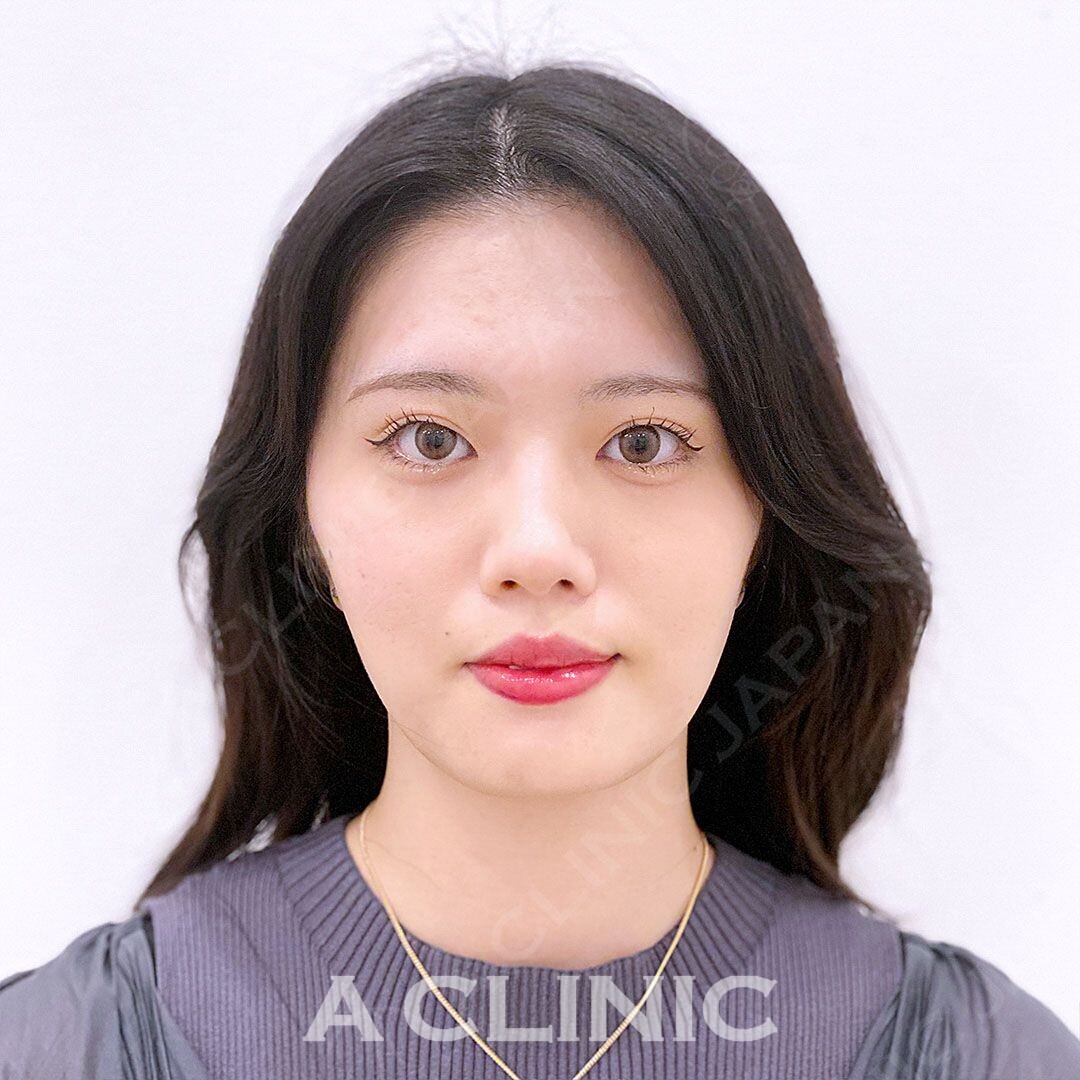 Aスレッドで当日からシュッとしたフェイスラインに！処置前と処置直後の症例です(20代女性) AFTER