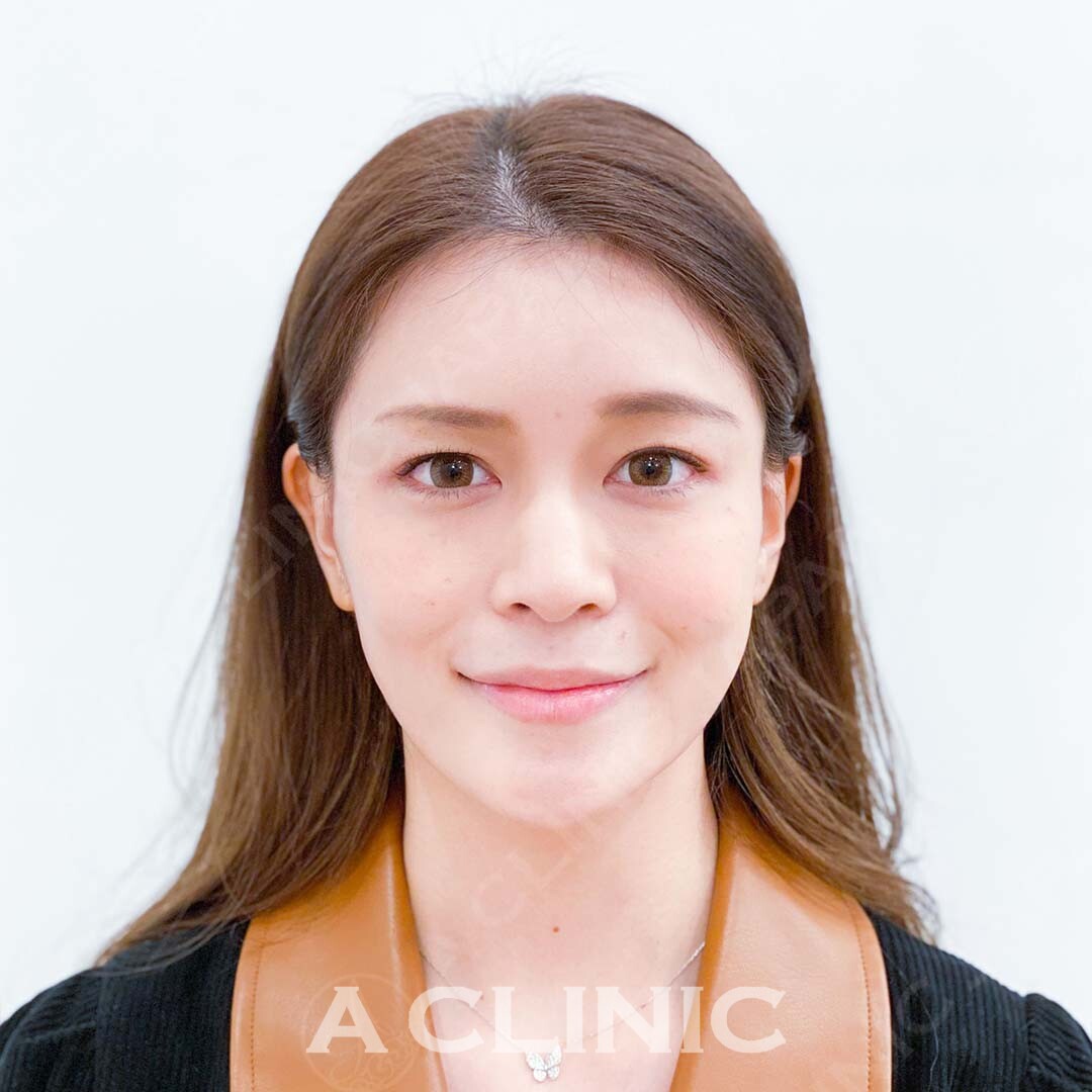 年々気になるお顔のたるみもAスレッドで一撃！処置前と処置直後の症例です(30代女性) AFTER