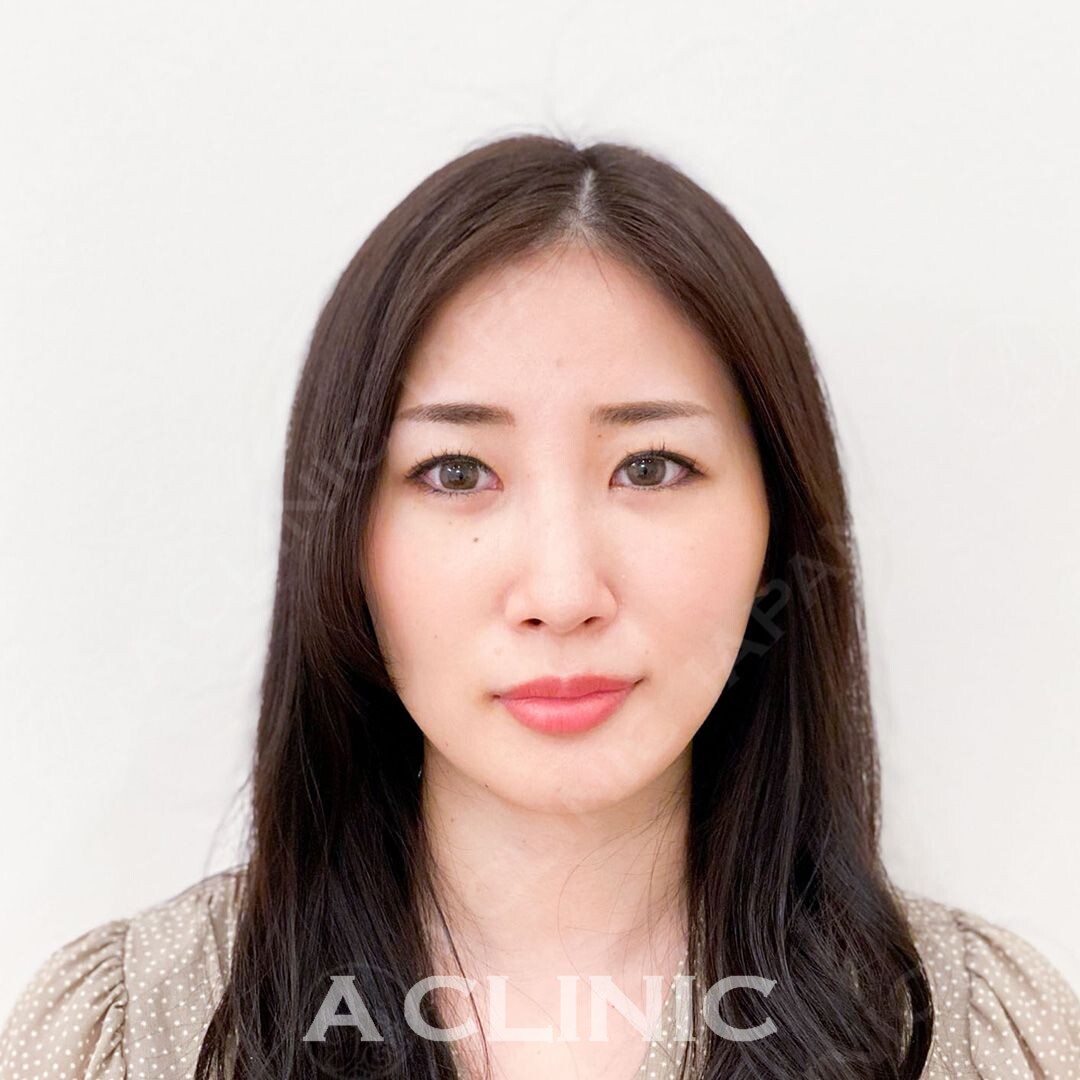 たるみを引き上げ輪郭を綺麗に整えます！Aスレッドの処置前と処置直後の症例です(30代女性) AFTER