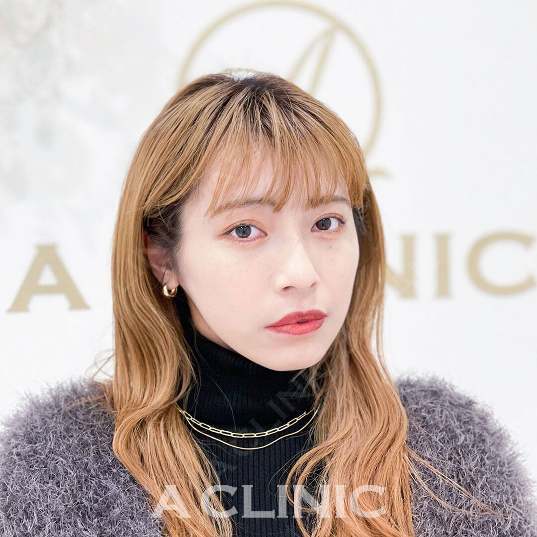 Aスレッドでフェイスラインの輪郭もスッキリ！処置前と処置直後の症例です(20代女性) AFTER