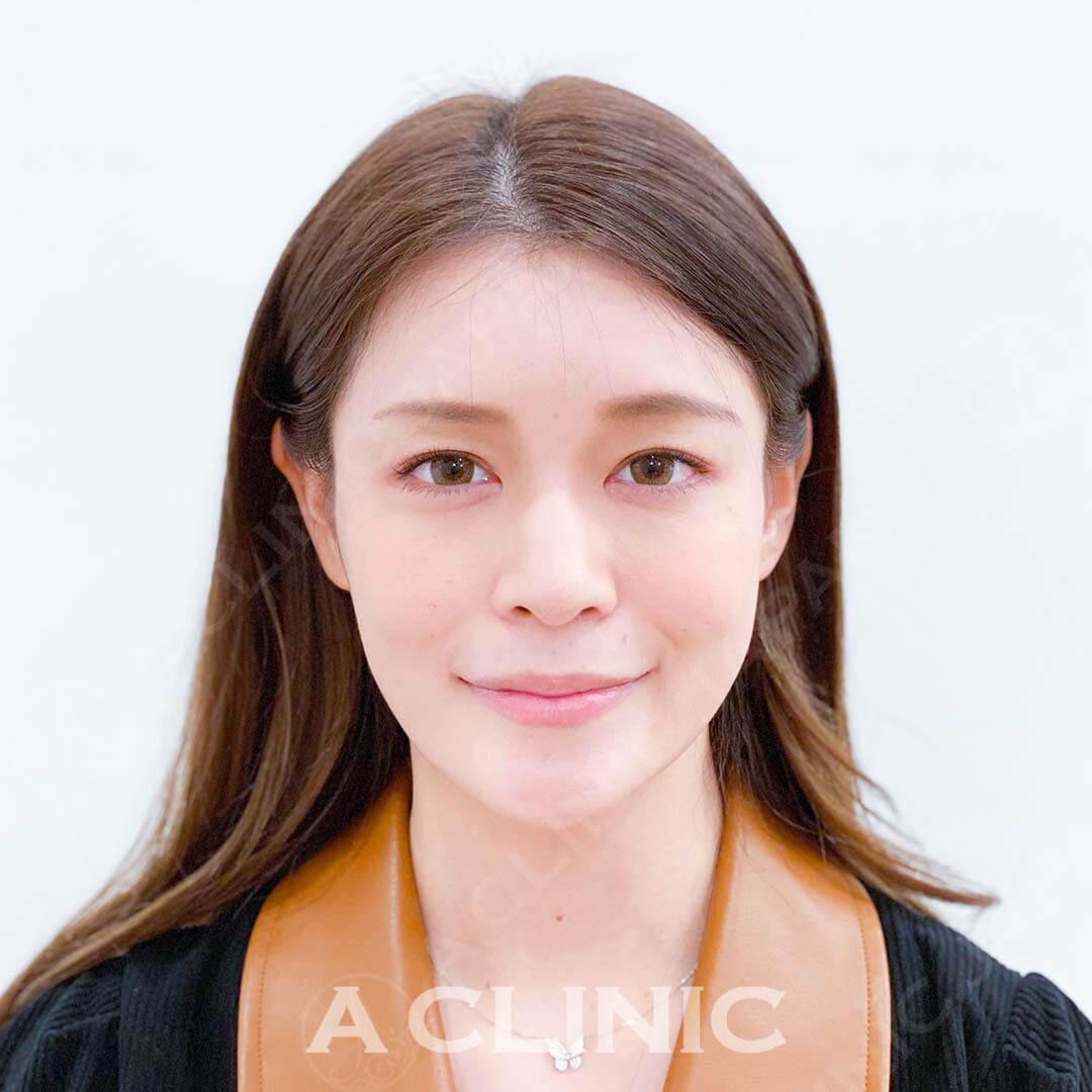 年々気になるお顔のたるみもAスレッドで一撃！処置前と処置直後の症例です(30代女性) BEFORE