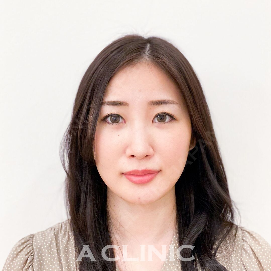 たるみを引き上げ輪郭を綺麗に整えます！Aスレッドの処置前と処置直後の症例です(30代女性) BEFORE