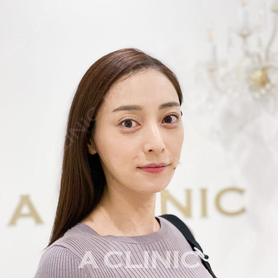 元々小顔の方でもしっかりリフトアップし更にシャープに！処置前と処置直後の症例です(30代女性) AFTER