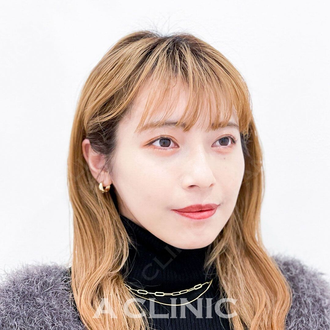 Aスレッドでフェイスラインが整い美人度が更に増しました！処置前と処置直後の症例です(20代女性) AFTER