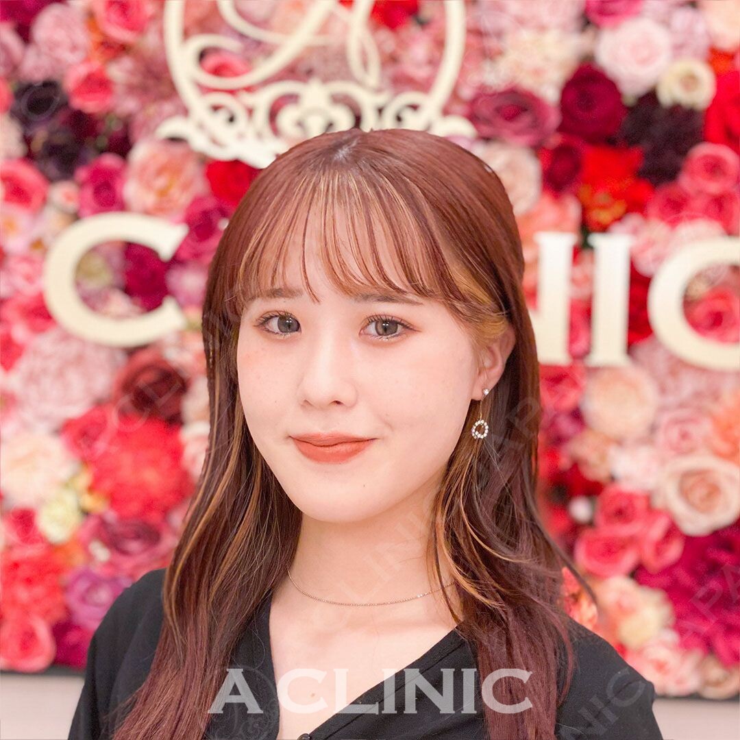 気になる頬のもたつきも即日解決！Aスレッドの処置前と処置直後です(20代女性) AFTER