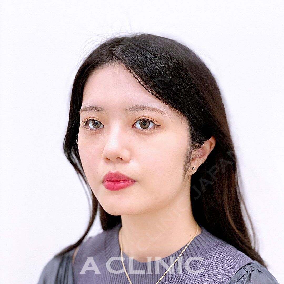 腫れの少ない糸リフトで直後から小顔に！Aスレッドの処置前と処置直後の症例です(20代女性) BEFORE