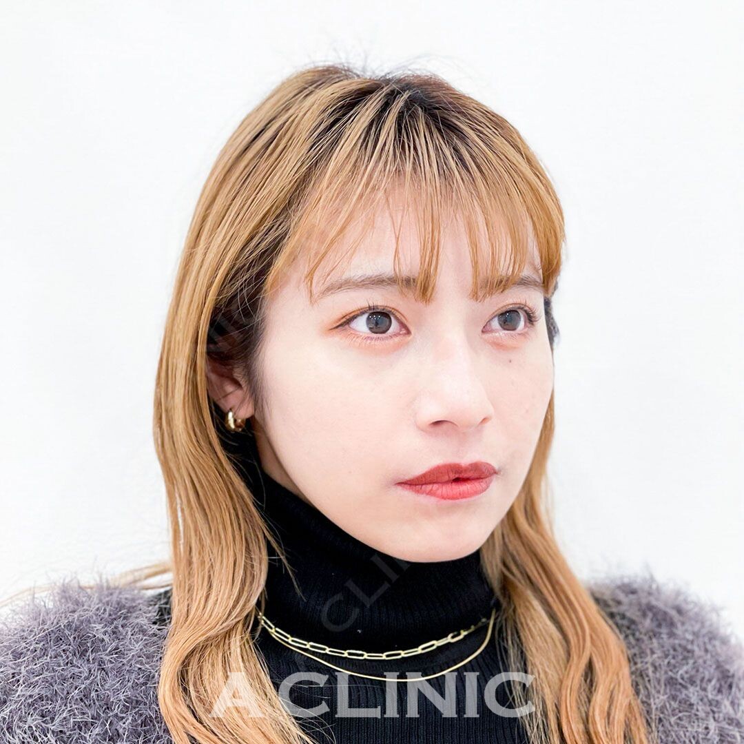 Aスレッドでフェイスラインが整い美人度が更に増しました！処置前と処置直後の症例です(20代女性) BEFORE