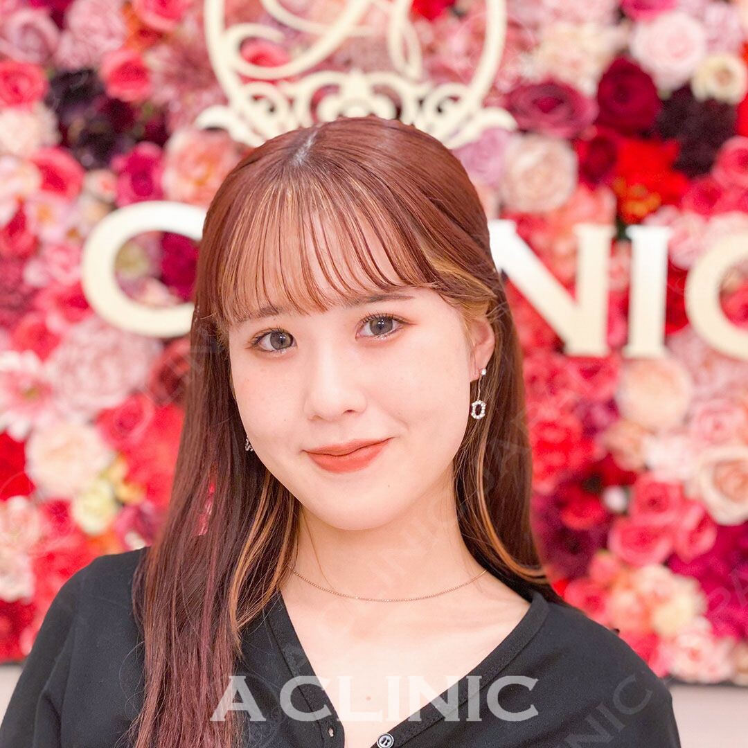 気になる頬のもたつきも即日解決！Aスレッドの処置前と処置直後です(20代女性) BEFORE