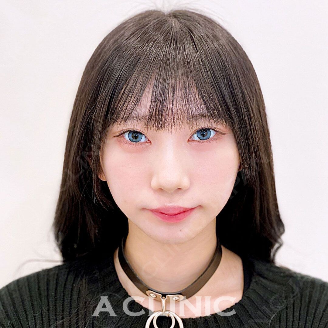 プクッと膨らんだ下膨れもシャープな輪郭に大変身！Aスレッドの処置前と処置直後の症例です(20代女性) AFTER