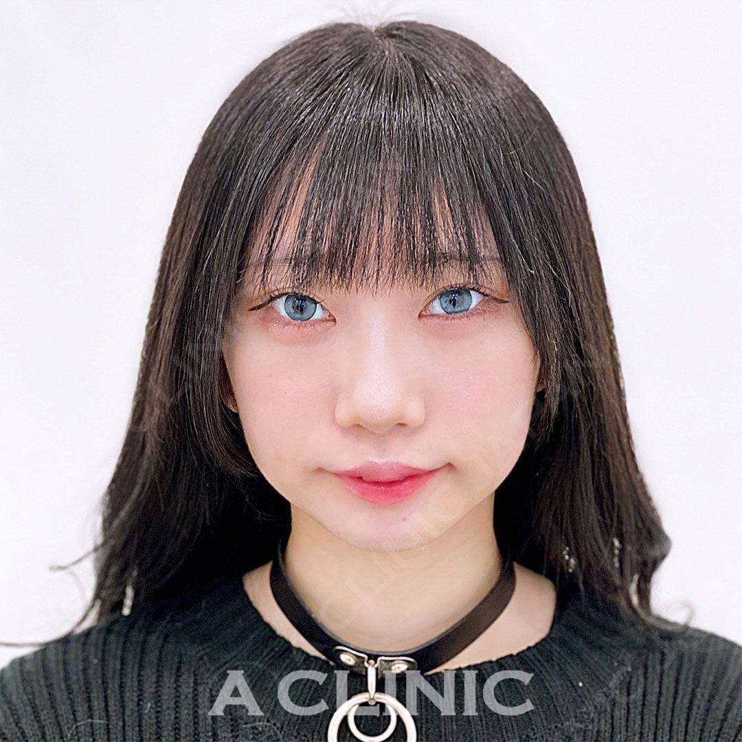 プクッと膨らんだ下膨れもシャープな輪郭に大変身！Aスレッドの処置前と処置直後の症例です(20代女性) BEFORE