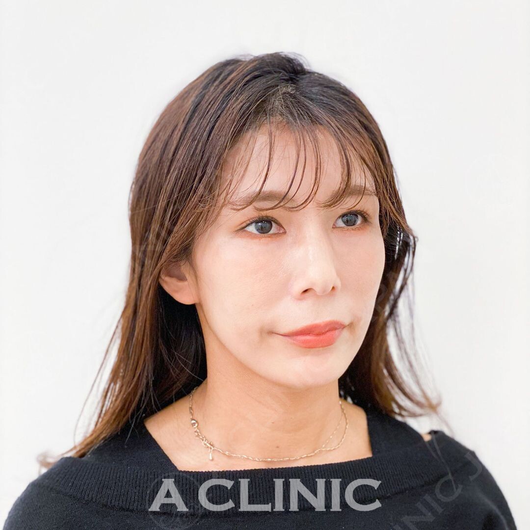 Aスレッドでフェイスラインのもたつきも当日からスッキリシャープに！処置前と処置直後の症例です(30代女性) BEFORE