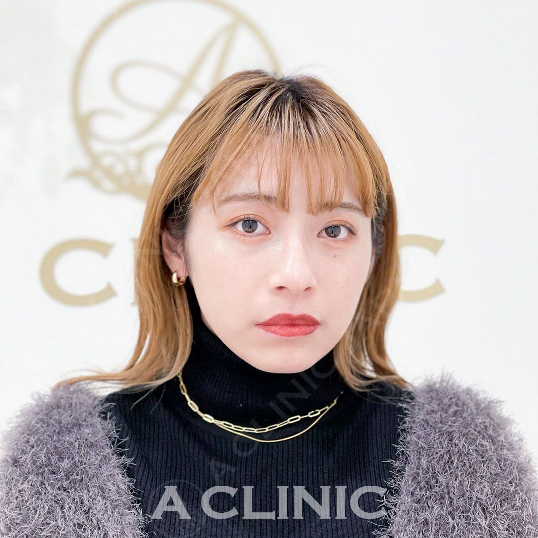 Aスレッドでフェイスラインの輪郭もスッキリ！処置前と処置直後の症例です(20代女性) BEFORE