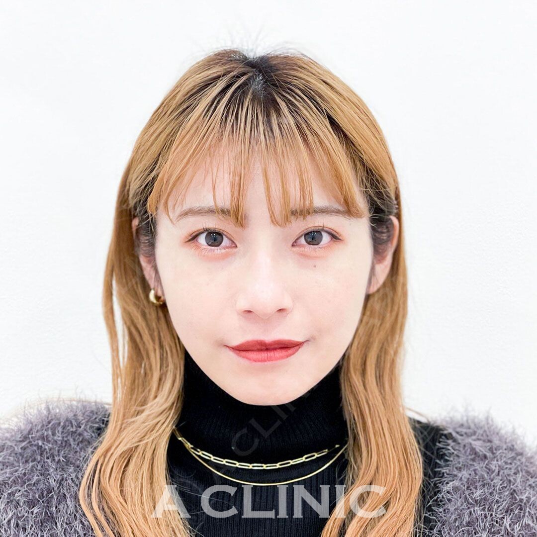 綺麗なVフェイスを当日から実感！Aスレッドの処置前と処置直後の症例です(20代女性) BEFORE