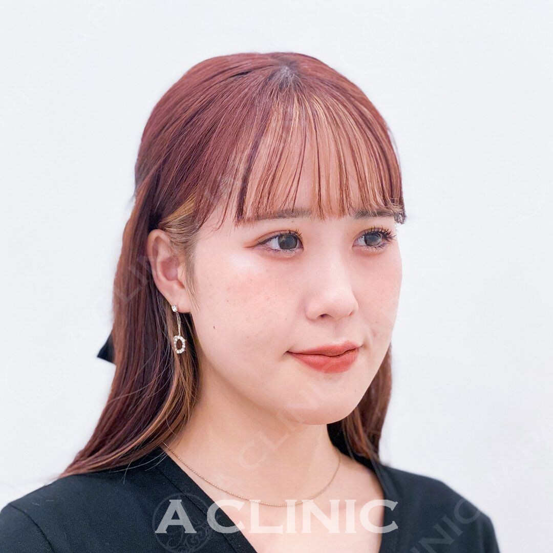 ダウンタイム最小限で直後から小顔に！当日お友達とお出かけも出来ちゃいます！Aスレッドの処置前と処置直後の症例です(20代女性) BEFORE