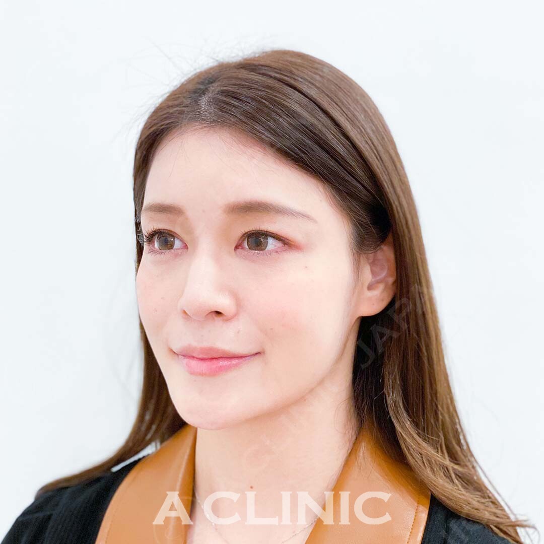 直後からしっかりリフトアップし小顔に！Aスレッドの処置前と処置直後の症例です(30代女性) BEFORE