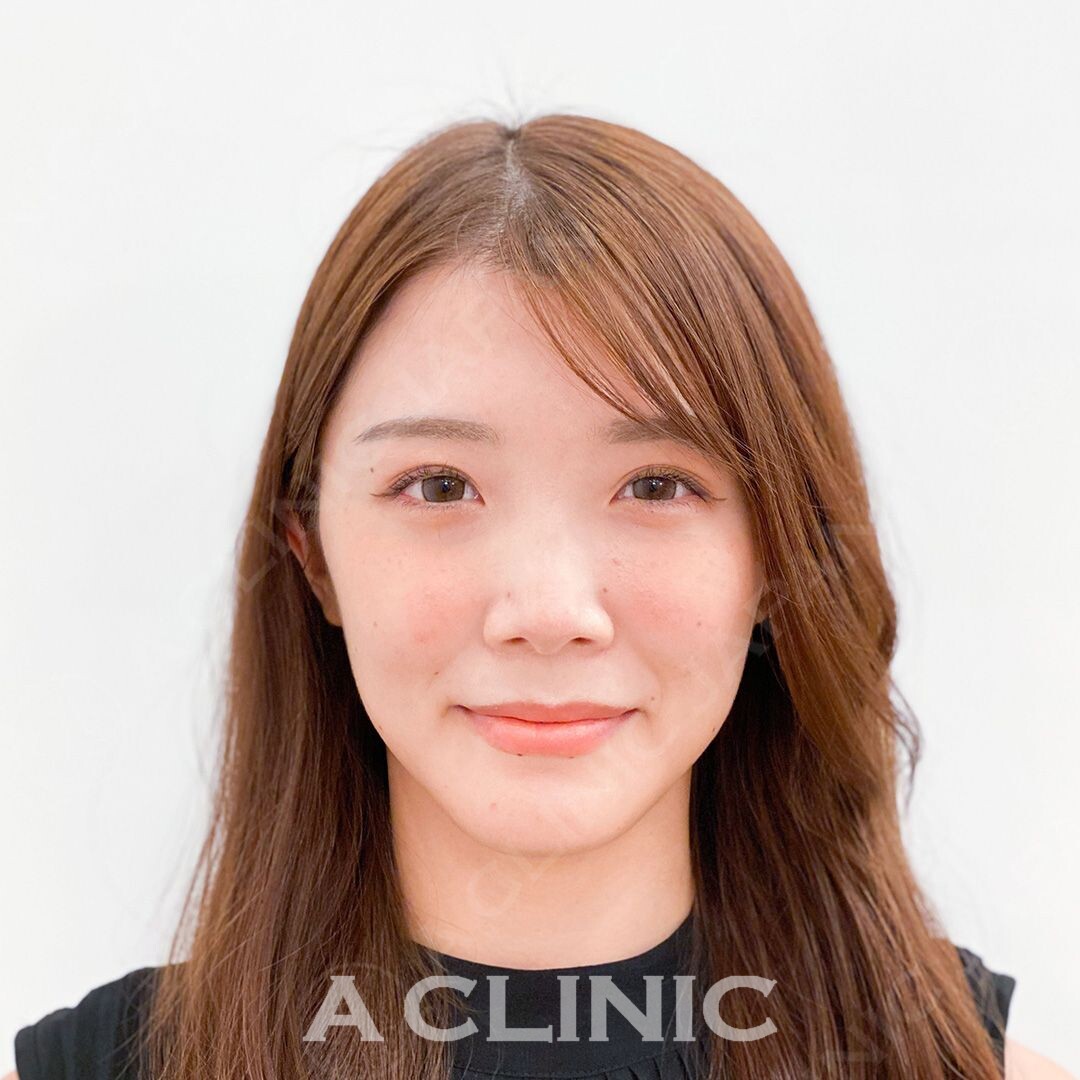 Aスレッドでお悩みの頬のもたつきもしっかり当日から解消！処置前と処置直後の症例です(20代女性) BEFORE