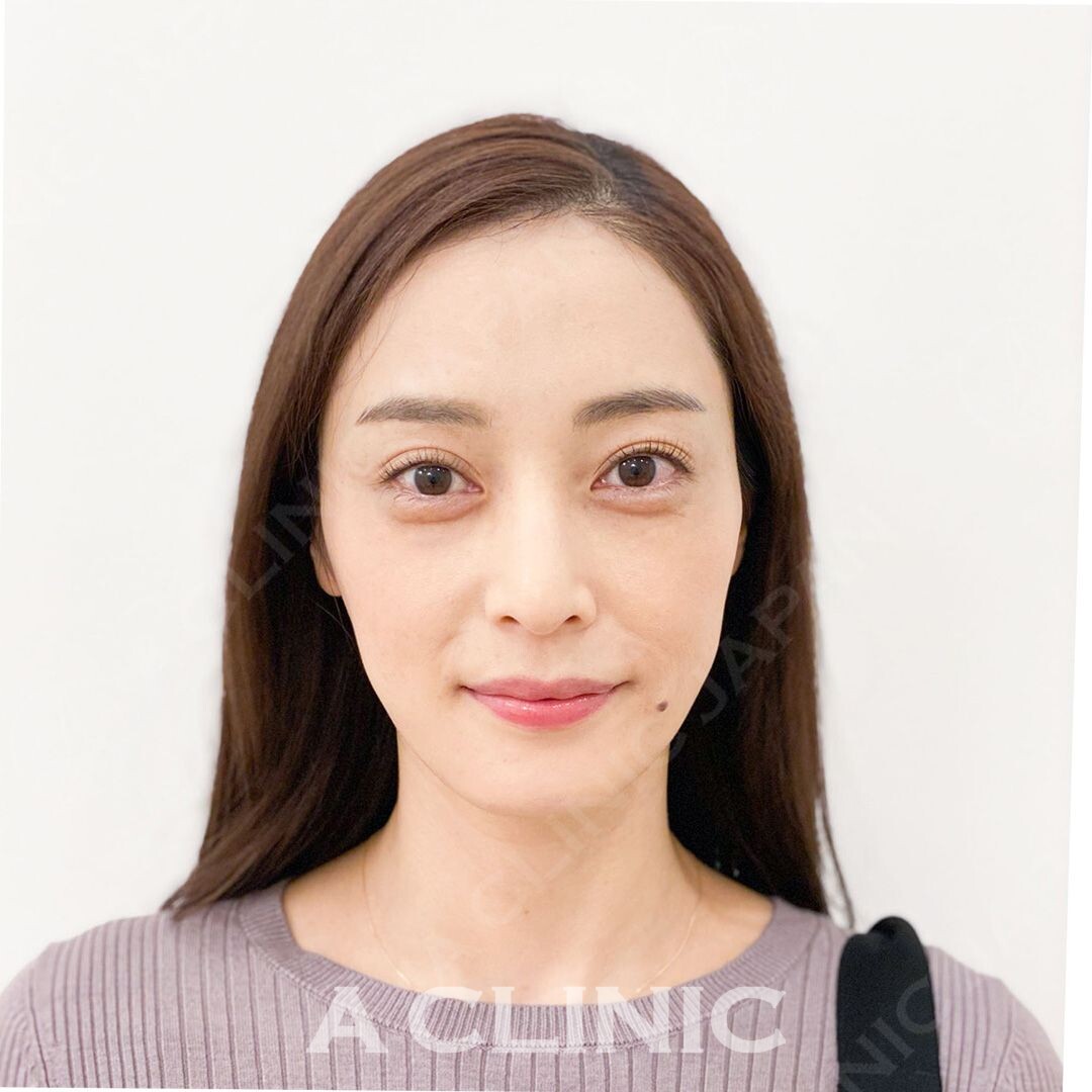 Aスレッドで頬のもたつきもしっかり解消！処置前と処置直後の症例です(30代女性) BEFORE