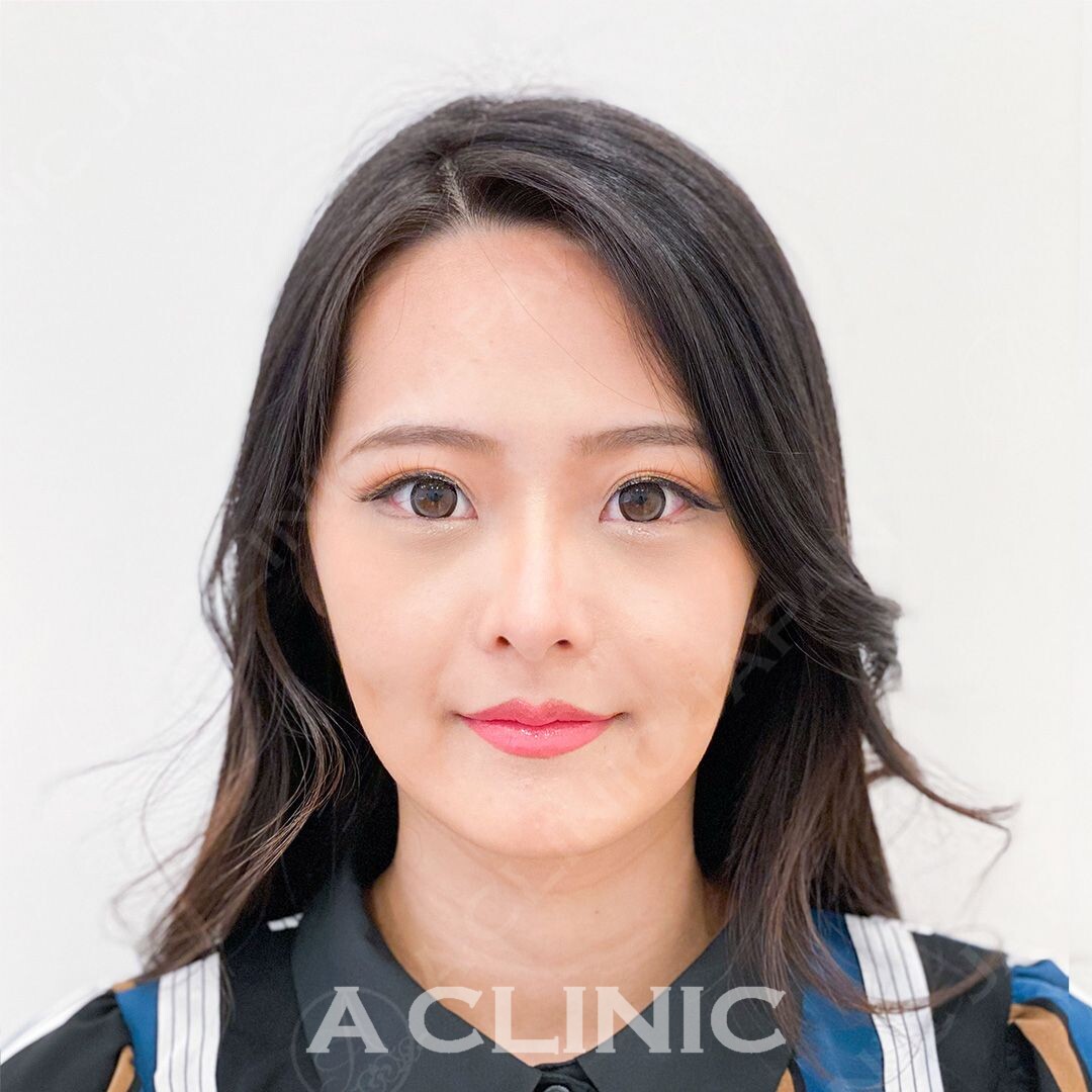 頬のたるみによるもたつきを即日解消！Aスレッド処置前と処置直後の症例です(20代女性) BEFORE