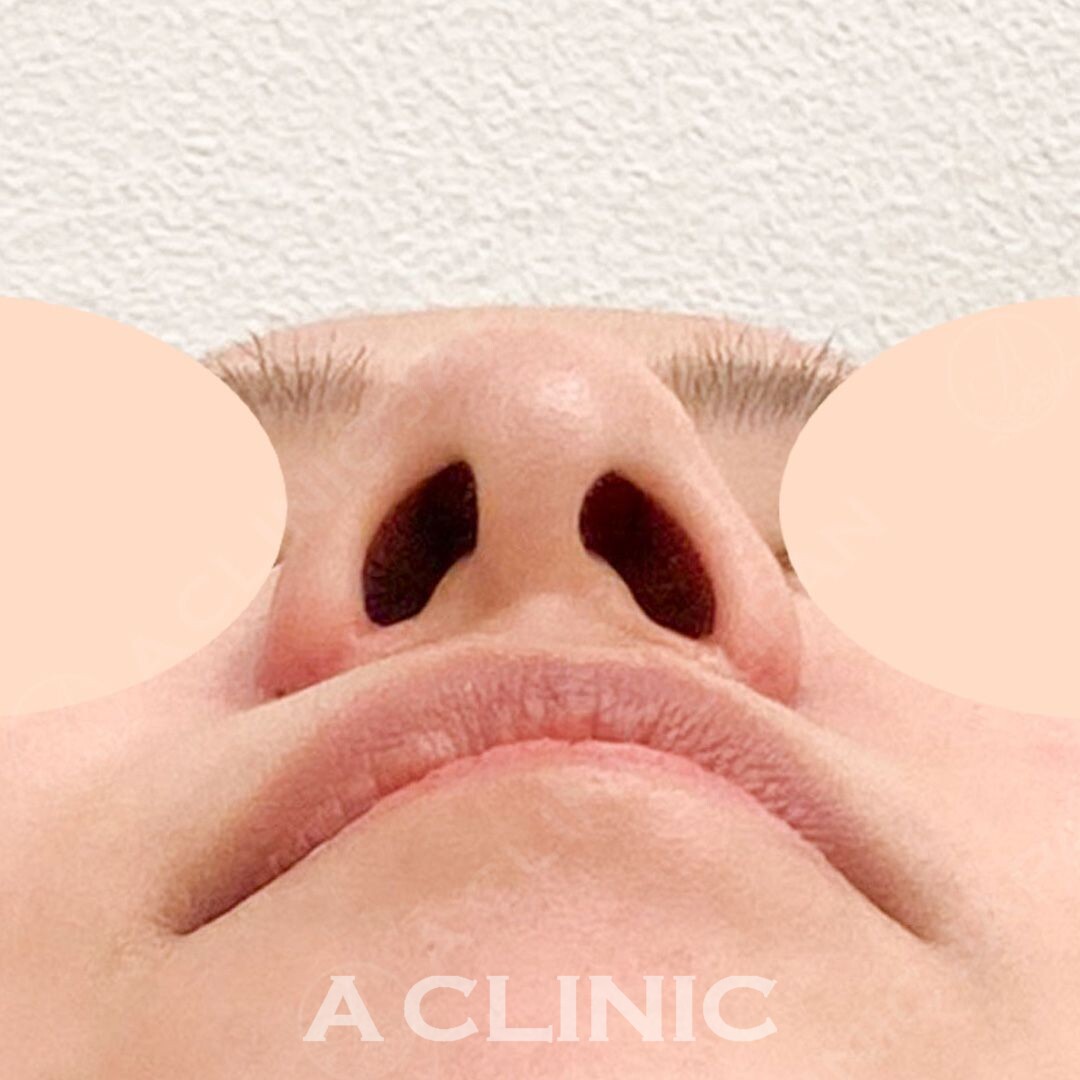 小鼻縮小術切開法でお悩みだった団子鼻を解消！こちら処置前と処置1ヶ月後の症例写真です(20代女性) AFTER