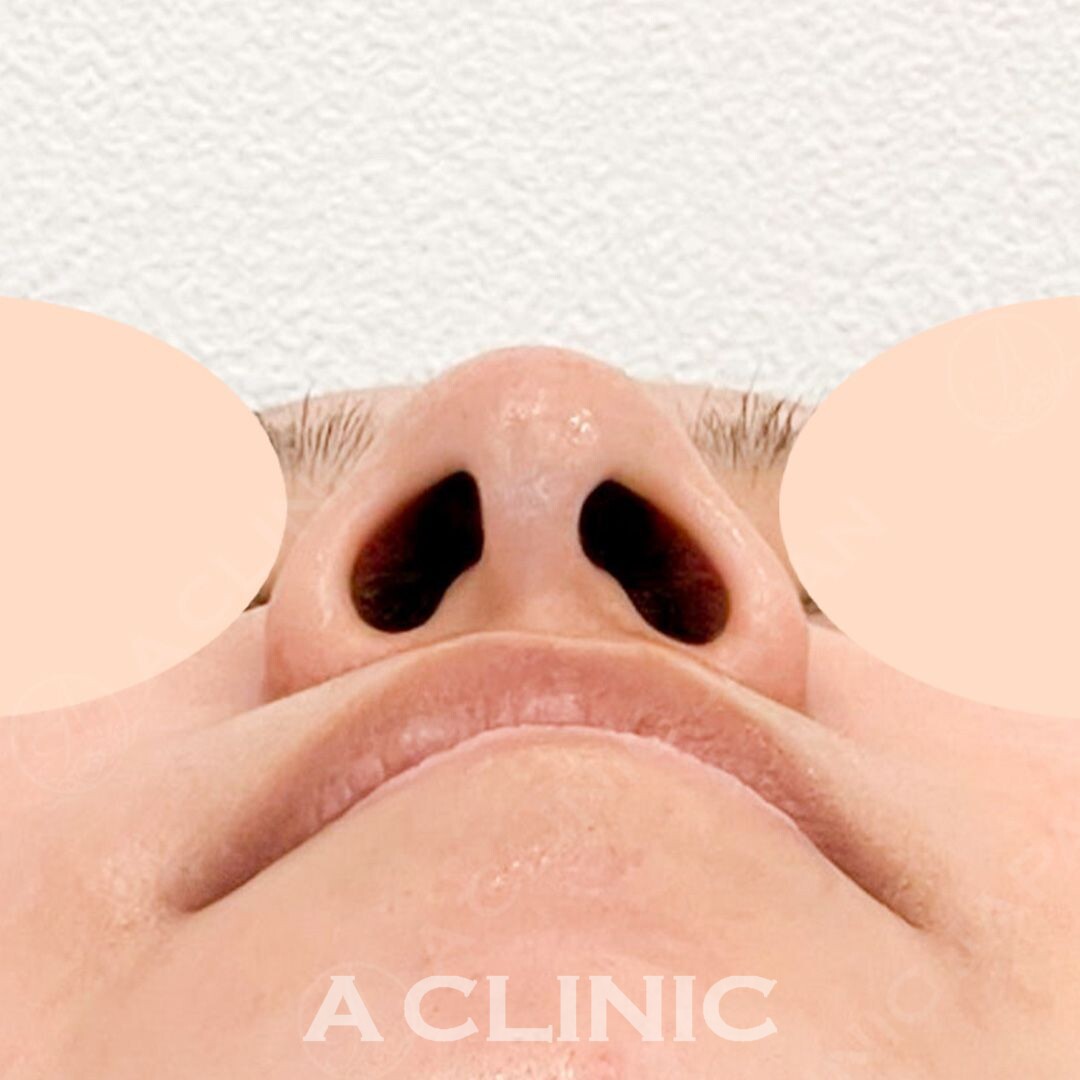 小鼻縮小術切開法でお悩みだった団子鼻を解消！こちら処置前と処置1ヶ月後の症例写真です(20代女性) BEFORE