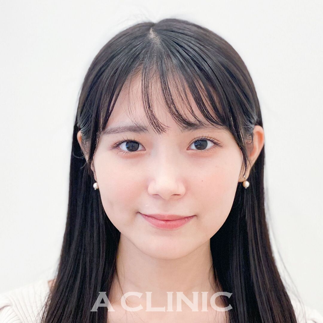 1day小顔脂肪吸引はご覧の通り3日後で仕上がりが綺麗な小顔に！処置前と3日後の症例です(20代女性) BEFORE