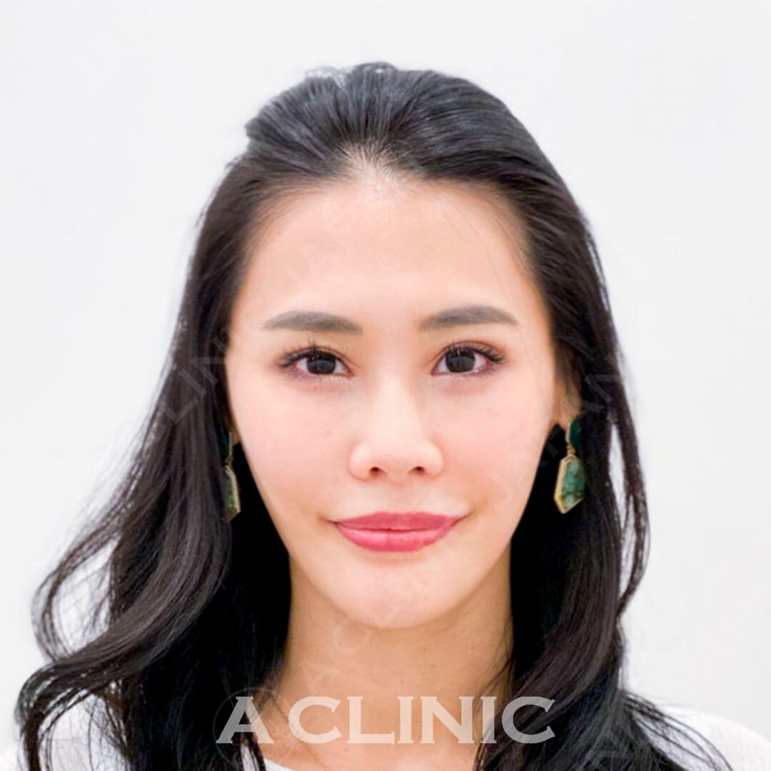 Aスレッドでアプリ加工いらずの小顔を手に入れませんか！処置前と処置直後の症例です(30代女性) AFTER