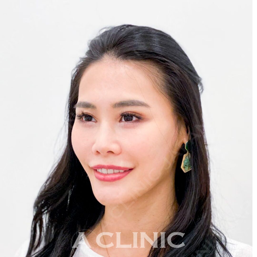 Aスレッドで気になるたるみやもたつきを瞬時に解決してくれます！処置前と処置直後の症例です(30代女性) AFTER